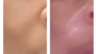 Hyperpigmentation Results in Just 3 weeks