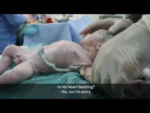 Doğumdan Sonra Kalbi Duran Bebeği Tekrar Hayata Döndürmek