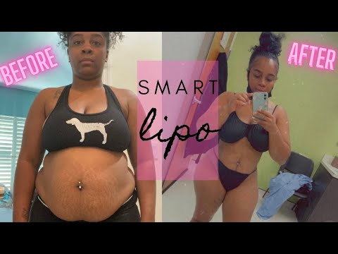 SMART LIPO AT SONO BELLO! |TWO WEEK POST OP | BEFORE  & AFTER PICTURES!Pt1