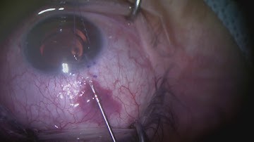 Dr. Bedrood - Ab Externo Xen Stent placement with closed conjunctiva