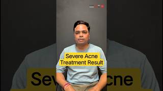 Severe Acne Treatment Result That Changed Everything! | Clear Skin Clinic, Pune