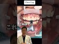 すきっ歯の方も矯正がおすすめです！ #大田区 #蒲田 #矯正 #すきっ歯 #歯医者