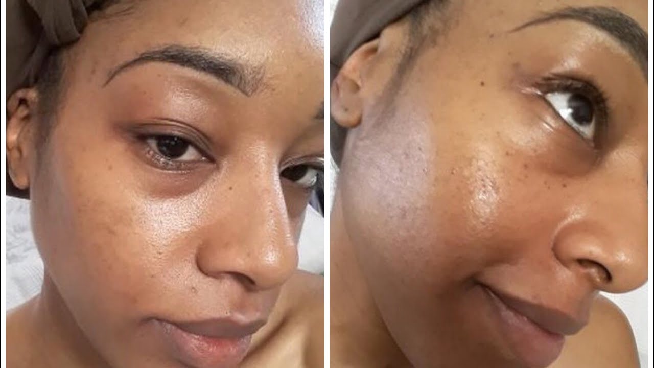 THE ONLY OIL I CAN USE THAT WONT BREAK ME OUT ACNE FREE GAME