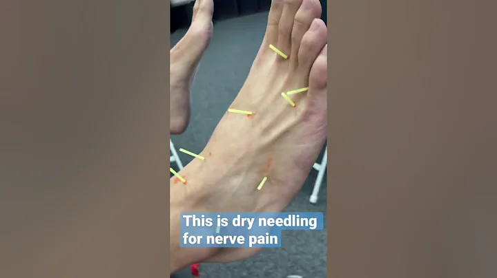 They Stuck 12 Acupuncture Needles into my Leg 😱 - DayDayNews