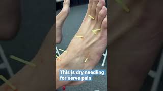 They Stuck 12 Acupuncture Needles into my Leg 😱 screenshot 1