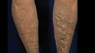 Essential Oils For Varicose Veins, Get Rid Of Varicose Veins, How Do You Get Rid Of Varicose Veins