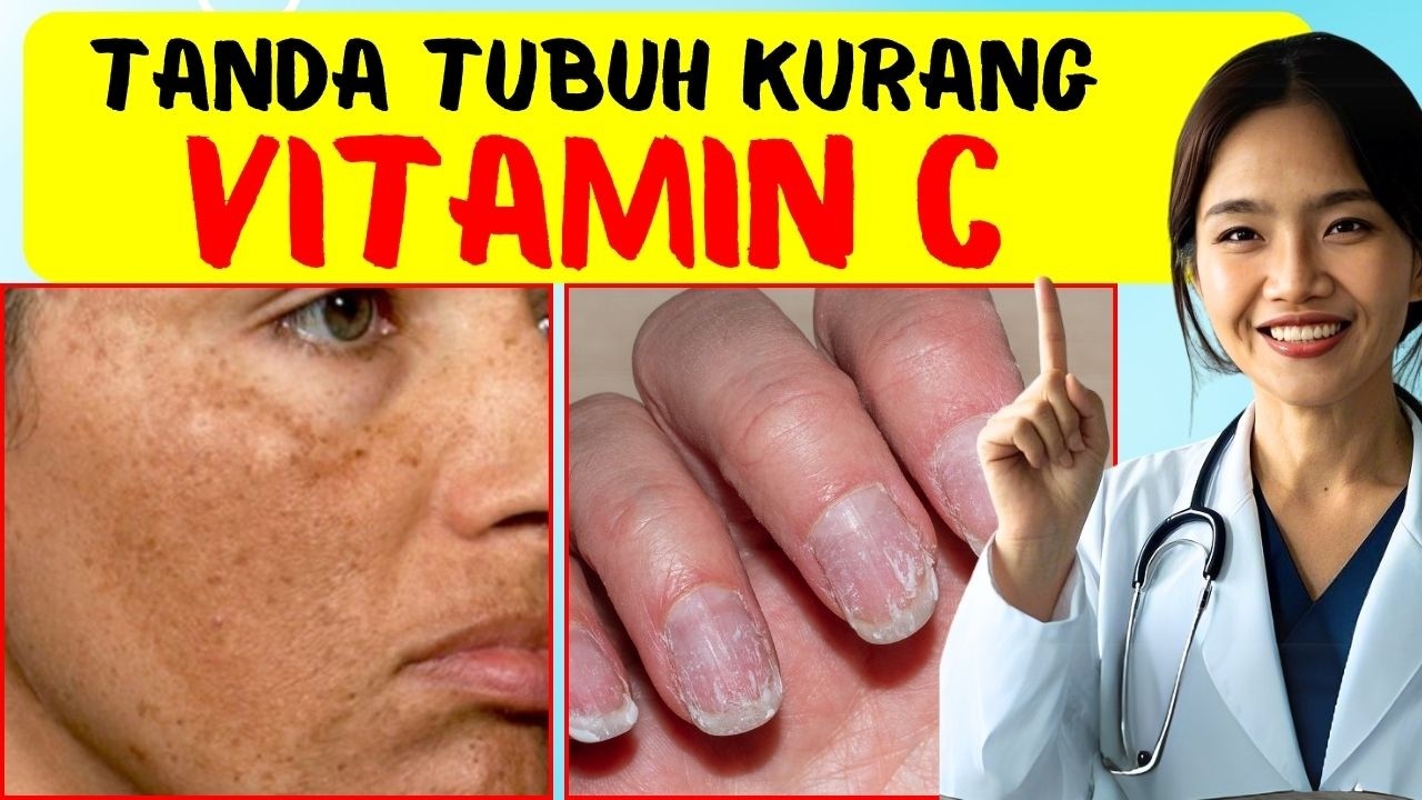 ПОЛЬЗА И ПРИЗНАКИ НЕДОСТАТКА ВИТАМИНА С ДЛЯ ОРГАНИЗМА | Доктор Эмасуперр