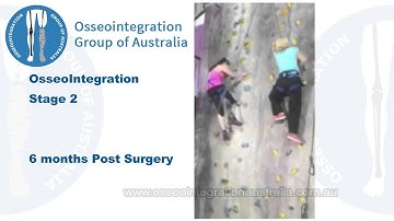 Osseointegration Patient - 6 months post surgery