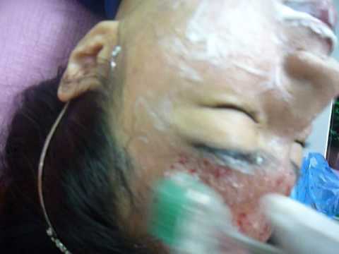 dermaroller-forehead.-2.5mm-192pin-dermaroller.-stem-cell-serum.-kampong-gajah-girl-1st-needling