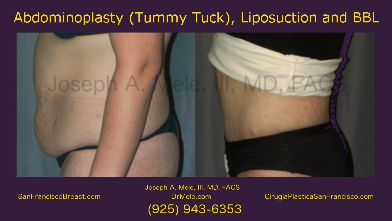 Mini Tummy Tuck Video (Mini Abdominoplasty) - SF Bay Area - 27 