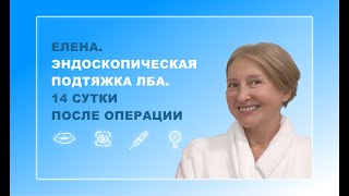 Елена. Эндоскопическая подтяжка лба. 14 сутки после операции