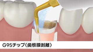 G95：Ultrasonic Scaler Tip（歯根膜剥離） – video｜NSK-Nakanishi Japan