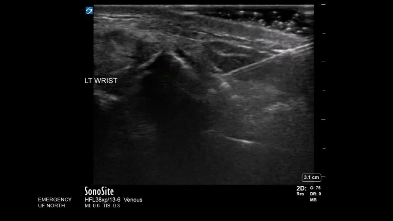 Wrist Ultrasound Distal Radius Fracture Hematoma Block YouTube