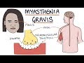 Myasthenia Gravis