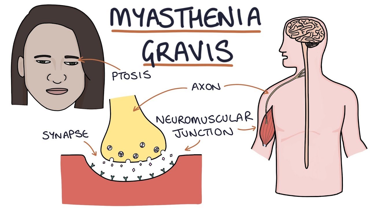 myasthenia gravis és látás