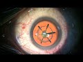 Live Post Polar Cataract Surgery by Dr Gaurav Luthra