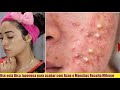 USE ESTA DICA JAPONESA PARA ACABAR COM ACNE E MANCHAS DA PELE