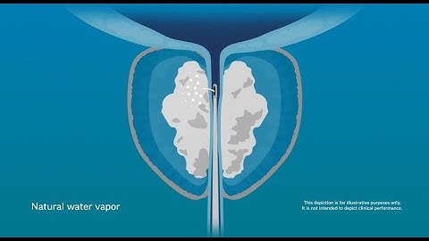 How it works: Rezūm™ Water Vapor Therapy