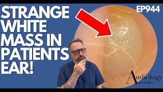 WHAT IS THIS STRANGE WHITE MASS IN PATIENTS EAR? - EP944