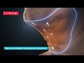 Facial Rejuvenation Treatment by Lutronic (3D animation)