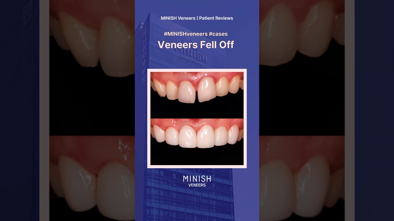 Patient Comes Back with the Veneers Pops Off? Here’s the Fix