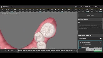 Clincheck for patient with challenging case