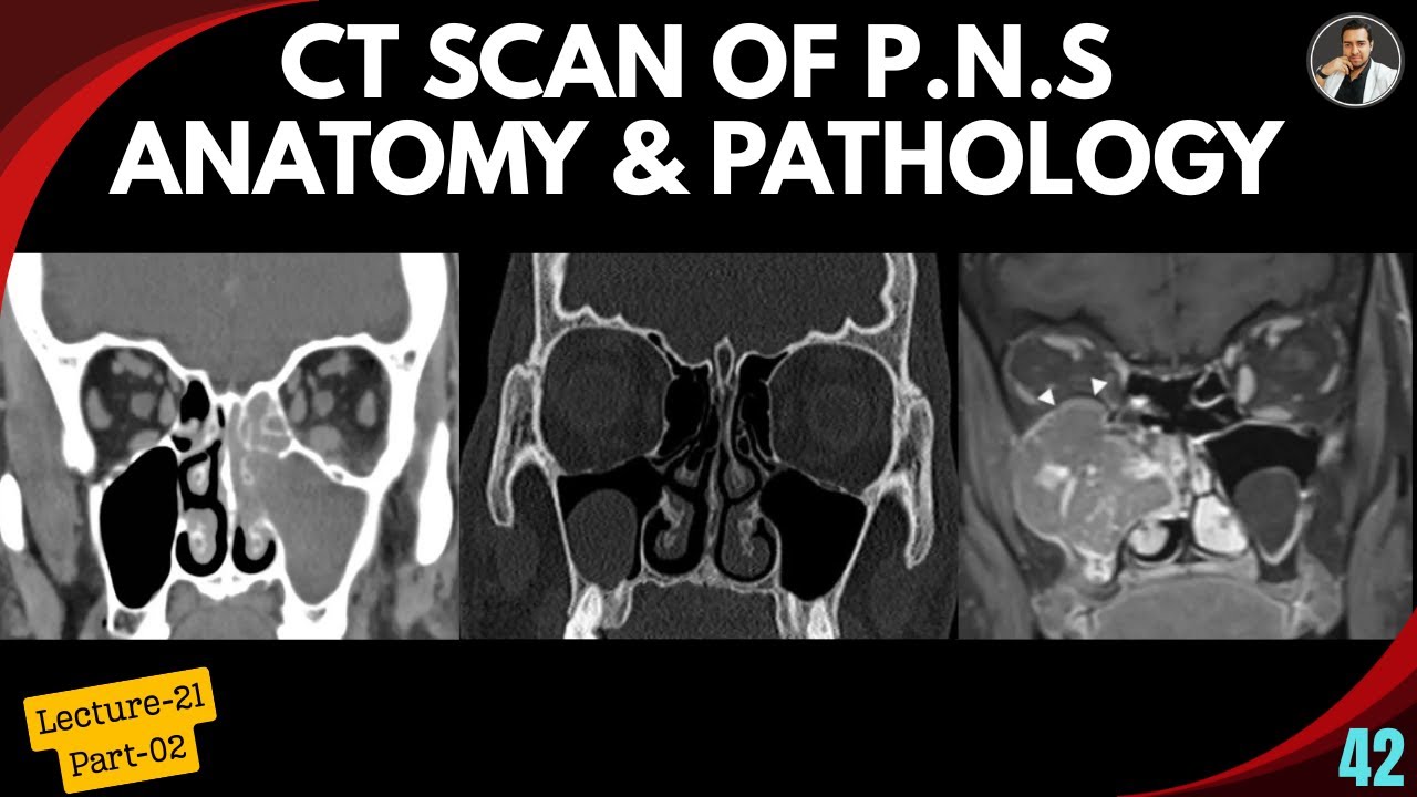 CT Scan PNS Anatomy and Pathology - Lecture:21 (Part-02) | Tutorial-42 | Acute Sinusitis | Mucocele|