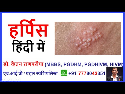 herpes simplex virus in hind | hsv ka meaning | hsv report | hsv igm | hsv test in hindi | hsv ka il