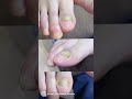 【肥厚爪ケア】#shorts