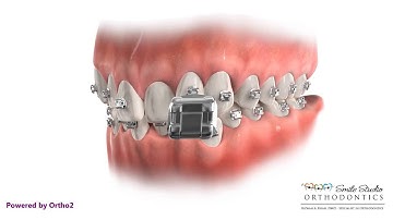 Damon Q Bracket -Braces