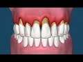 Diş Eti Çekilmesi Nedir ? Nedenleri, Belirtileri Ve Tedavi Süreci