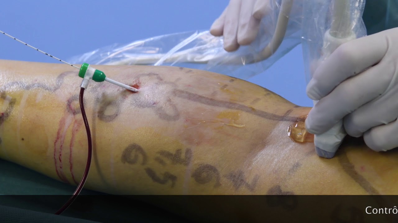 procedura de la varicoza tensiunea arteriala i varicoza