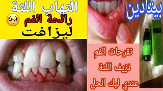 علاج رائحة الفم الكريهة ونزيف اللثة وفطريات الفم