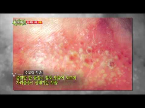 [HIT] 비타민-말 못할 고통 &rsquo;무좀&rsquo;의 원인과 증상.20140702