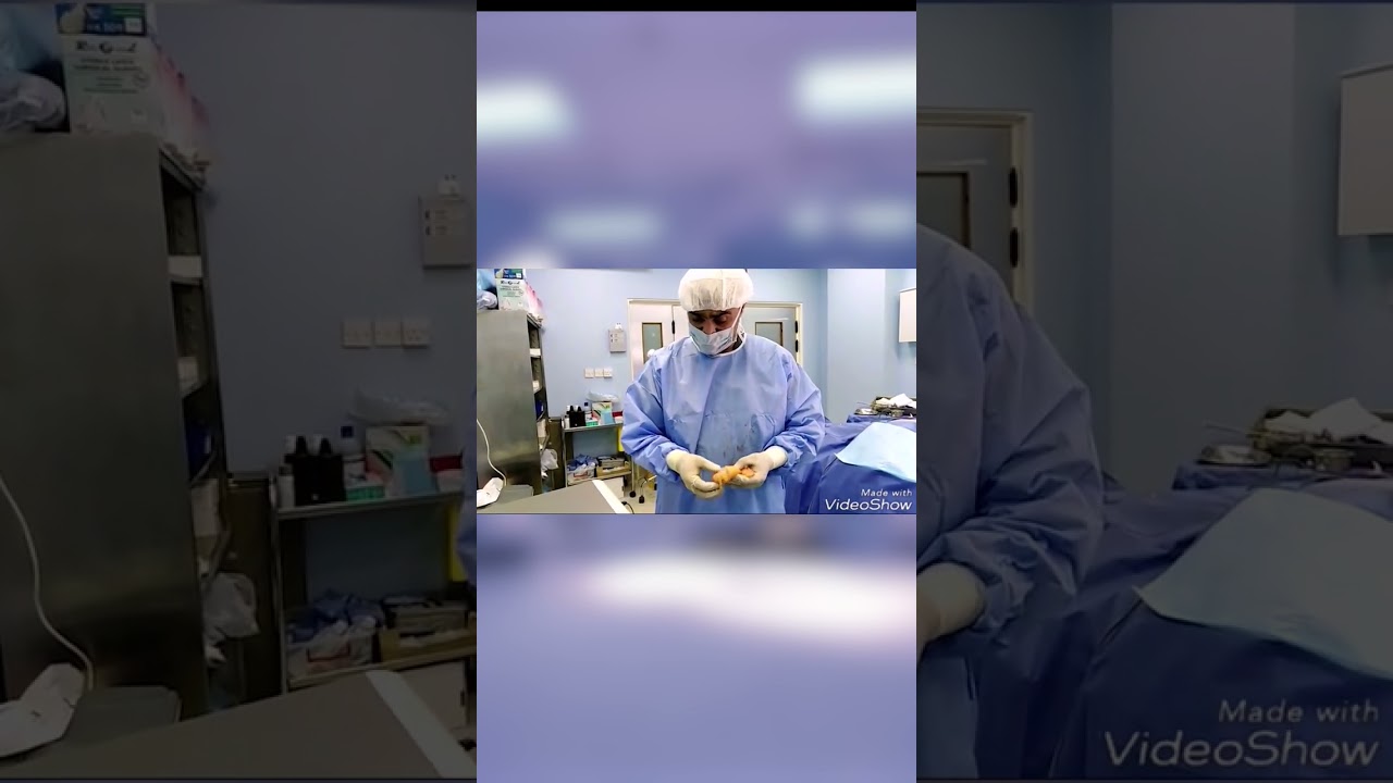 التخلص من التثدي بشفط الدهون بالفيزر  او الشفط التقليدي