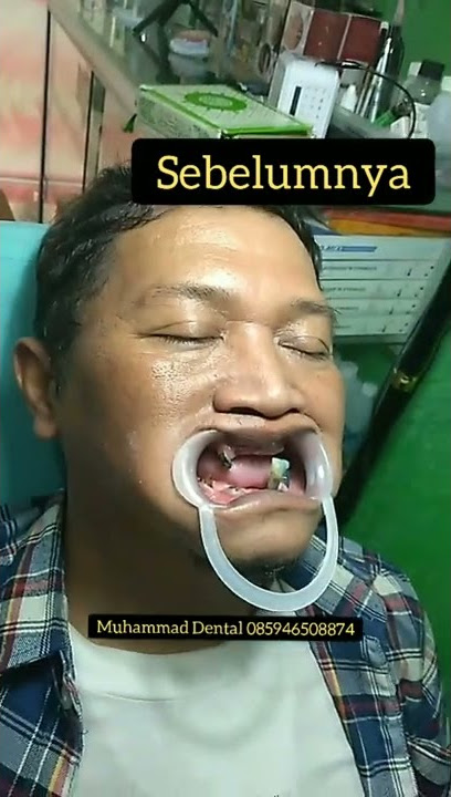 Bapak ompong jadi rapi tanpak muda lagi denga gigi barunya.
