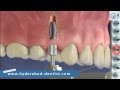 Replacing Failed Dental Implant | Multiple Tooth Implants Hyderabad