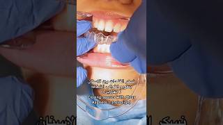 تقويم الأسنان الشفافस्पष्ट ब्रेसिज़ clear alignersorthodontics dr_abdullah_sultan_dentist dentist