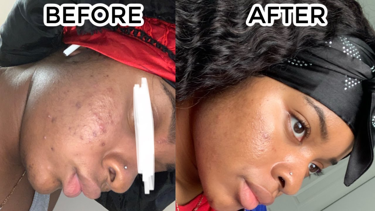 How I Cleared My Skin | Skin Care Routine - YouTube