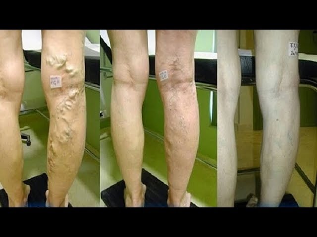 Heilen Sie Ihre Krampfadern mit einer Mischung aus Aloe Vera, Karotten und  Apfelessig - YouTube