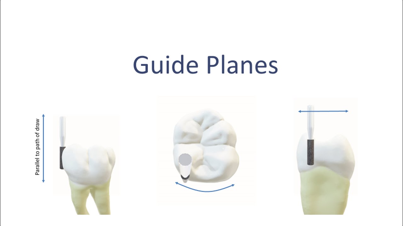 RPD Guide Plane Preparation In 1 Min YouTube RPD Guide Plane Preparation In 1 Min YouTube