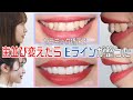 【セラミック治療】出っ歯・八重歯を治したらEライン改善しました【行程公開】湘南歯科クリニック