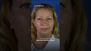 Омоложение за 1 день | Подтяжка лица без шрамов