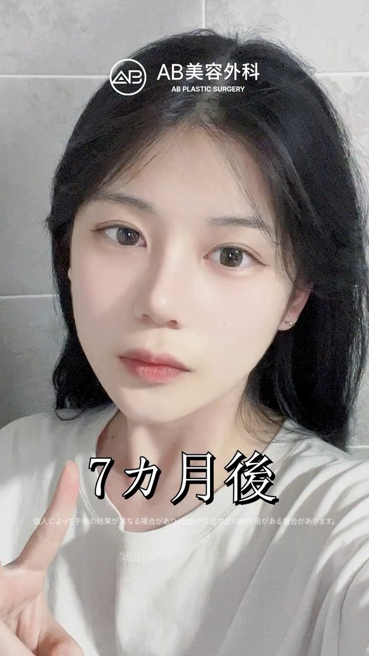輪郭3点・鼻整形で「可愛い」が加速した🤍 #Shorts