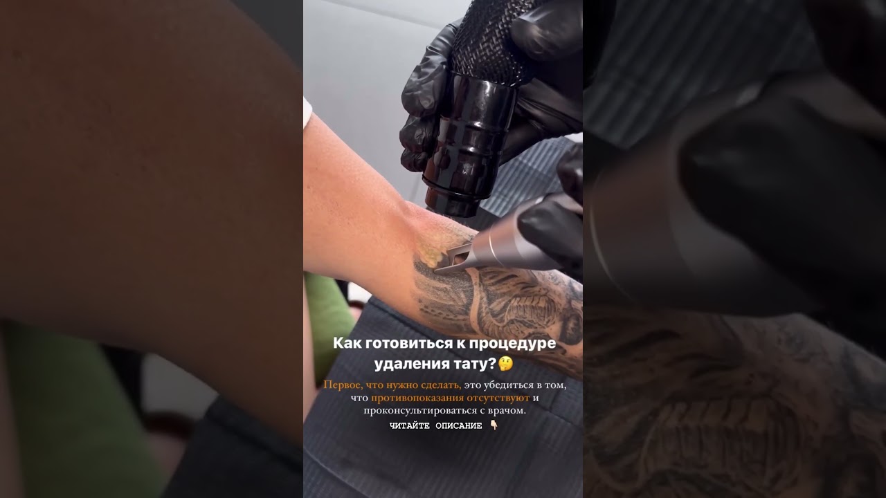 Противопоказания для удаления тату‼️