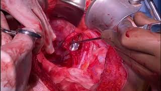 Nüks Over Kanseri̇nde Bi̇lateral Obturatuvar Lenf Nodu Di̇i̇yonu