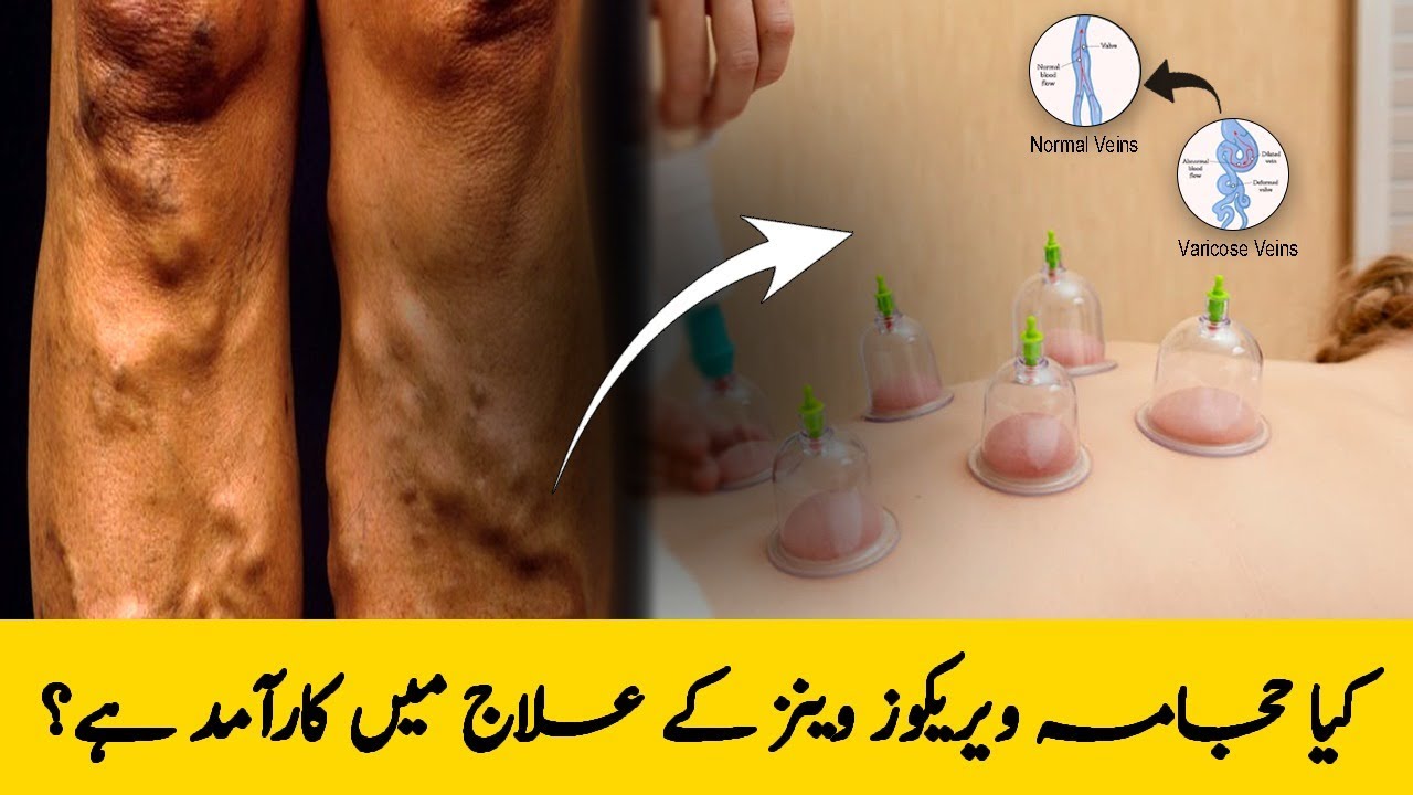 Is Hijama (Cupping Therapy) Effective for Varicose Veins Treatment?