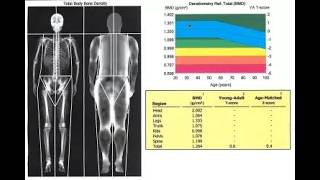 BMD bone mineral density; measure of how much calcium and other minerals are present in your bones