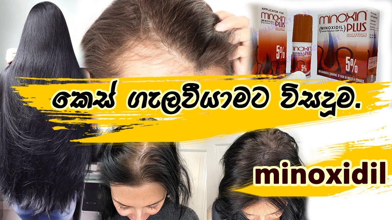 Hair Loss Treatment Sinhala Sinhala Medical Channel YouTube