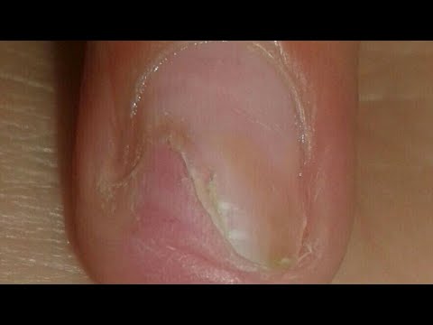 How to fix damaged nail - YouTube